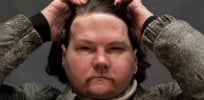 Full face and hand transplants give badly burned man ‘new chance at life’